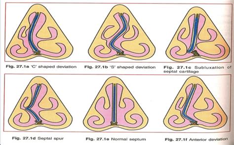 Classification & Types of Deviated Septums - Deviated Septum Information & Advice