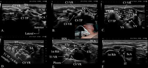 Reliability of a sequential ultrasound imaging technique (SUIT) to ...