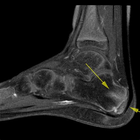 Calcaneal apophysitis (Sever disease) | Image | Radiopaedia.org