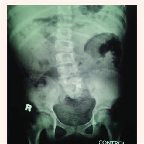 (PDF) Sacral Agenesis with Isolated Neurogenic Bladder Dysfunction Case Report