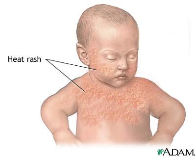 Infant heat rash: MedlinePlus Medical Encyclopedia Image