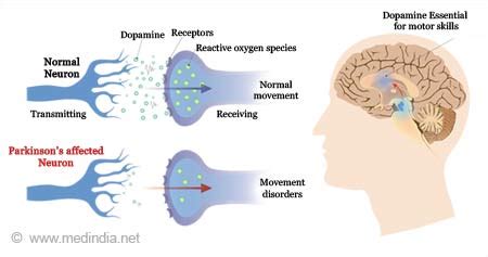 What Neurons Does Parkinsons Affect: Unveiling The Brains Role