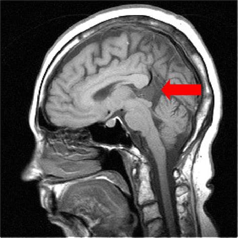 Brain MRI, Sagittal T1 showing incidental 17 mm pineal cyst | Download Scientific Diagram