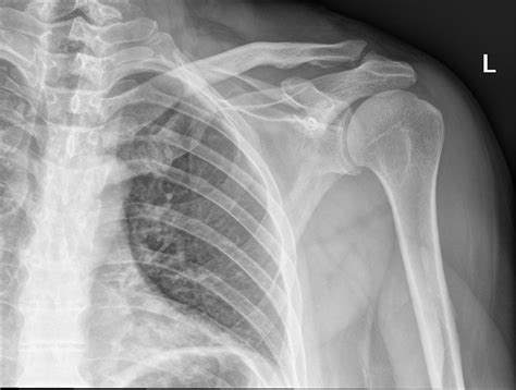 Right Scapula Fracture