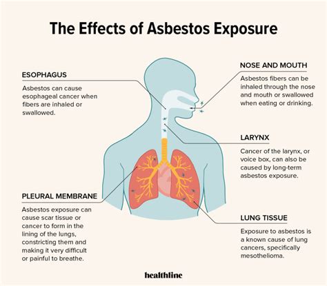 Understanding Asbestosis: Causes, Symptoms, And Treatment - Ask The Nurse Expert