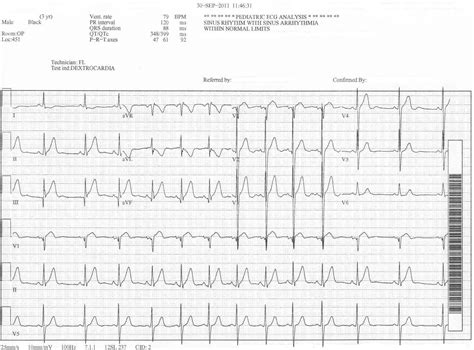 Pedi cardiology: EKG: Dextrocardia