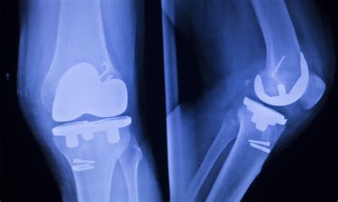 DePuy Attune Knee Replacement Failure & Risks | Unsafe Products