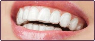 Quick Straight Teeth in Tamworth & Lichfield | Ascent Dental Care Tamworth