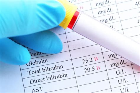 Symptoms and Causes of Low Bilirubin levels – ActiveBeat – Your Daily Dose of Health Headlines