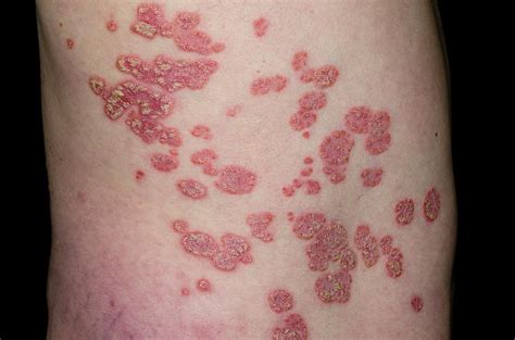 Plaque Psoriasis On The Skin Photograph by Dr P. Marazzi/science Photo Library