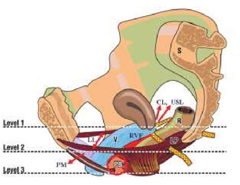 -Fig. 31 Three level repair: Level 1 cardinal ligament (CL) and... | Download Scientific Diagram