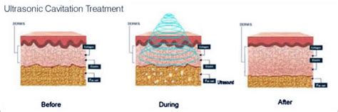 Ultrasound Cavitation - Biodecus