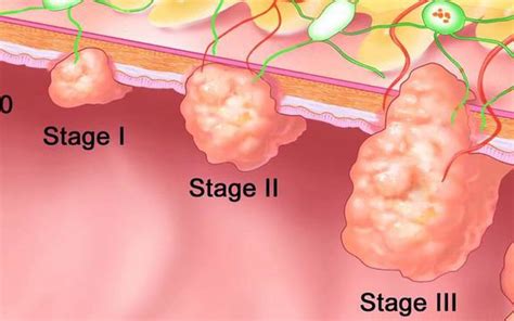 Rectal Cancer Home Remedies: Can Rectal Cancer Heal Without Surgery