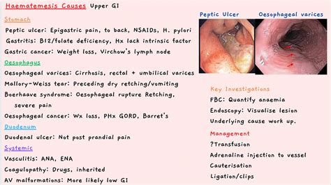 Haematemesis Causes