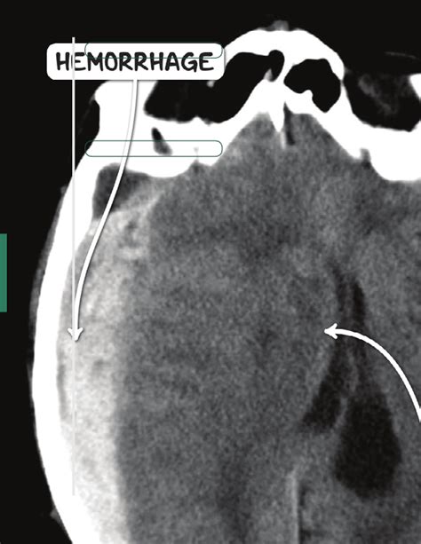 Increased intracranial pressure Notes: Diagrams & Illustrations | Osmosis