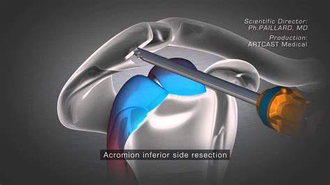 Shoulder Arthroscopy - Acromioplasty - YouTube