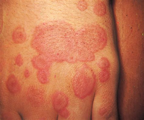 Study Medical Photos: Introduction To Erythema multiforme