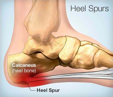 Heel Pain: Heel Spur Symptoms and Treatment