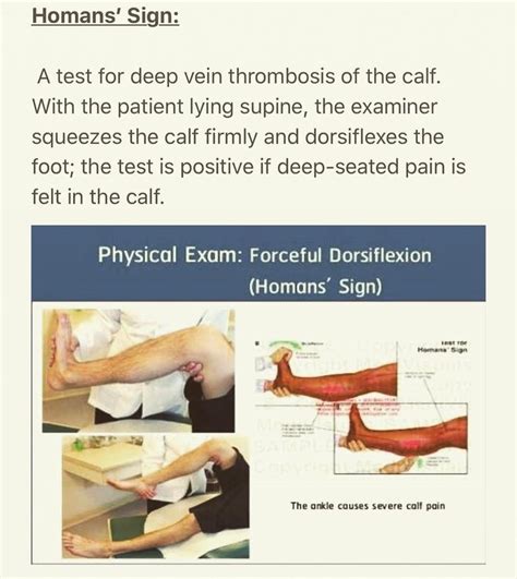 Pin by Alexis Kurtz on RN | Homans sign, Deep vein thrombosis, Thrombosis