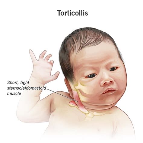 TORTICOLIS - Cirugia de Columna en Matamoros