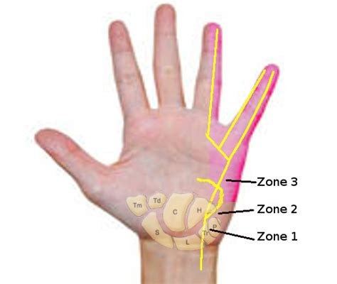 Anatomy, Shoulder and Upper Limb, Hand Guyon Canal - StatPearls - NCBI Bookshelf