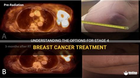 Understanding The Options For Stage 4 Breast Cancer Treatment | MedShun