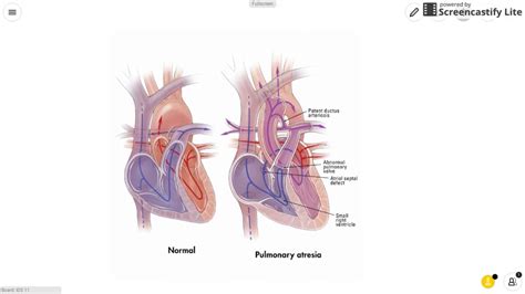 Pulmonary Atresia