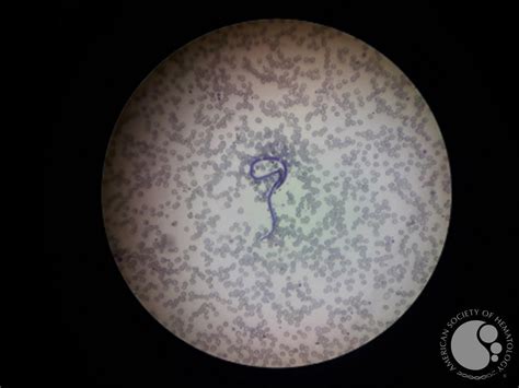 Microfilaria seen in same case in peripheral blood smear.