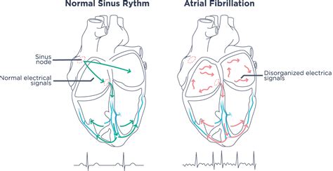 AFib: Atrial fibrillation symptoms and diagnosis | Withings