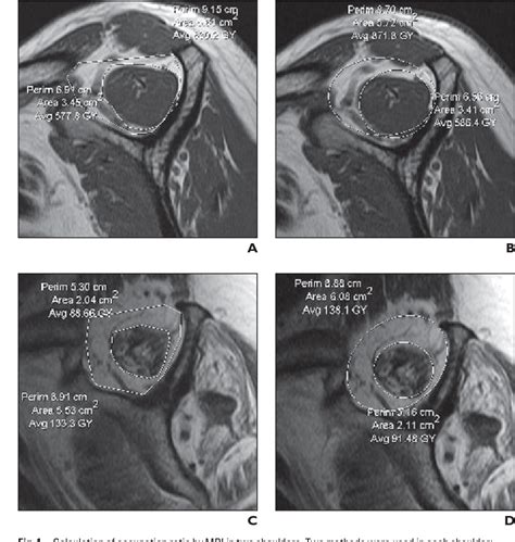 Atrophy and fatty infiltration of the supraspinatus muscle: sonography versus MRI. | Semantic ...