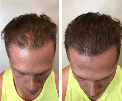 Scalp Micropigmentation Las Vegas | Hides Thinning Hair & Receding ...