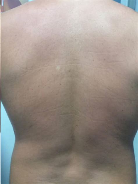 Laser Back Hair Removal | Permanent Hair Removal | Urban Body Laser