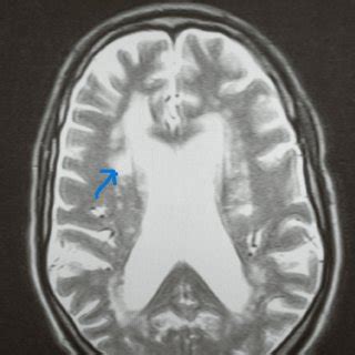 MRI showing nonspecific periventricular and deep white matter... | Download Scientific Diagram