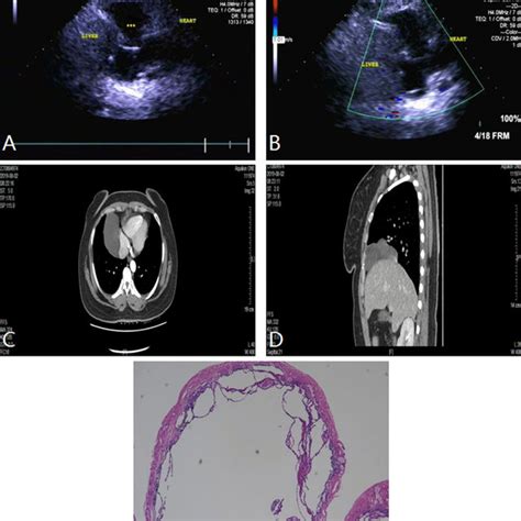 Anterior mediastinal mass (thymoma) in a 30-year-old woman. A and B TTE... | Download Scientific ...