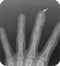 Distal Phalanx Tuft Fracture