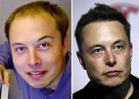 Elon Musk Before and After Plastic Surgery: Hair transplant