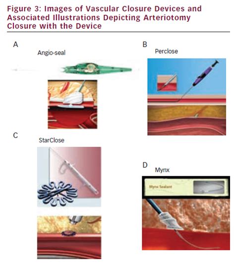 Images of Vascular Closure Devices and Associated Illustrations ...