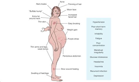 Signs and symptoms of Cushing's disease | Download Scientific Diagram