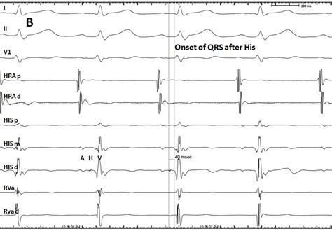 Wolff Parkinson White Syndrome - The Cardiology Advisor