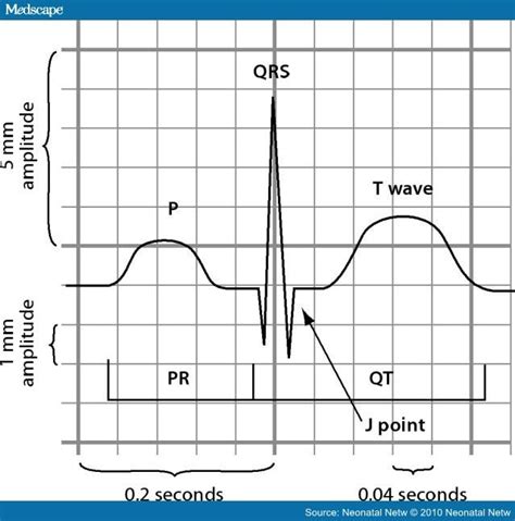 gw manis: Retrograde P Wave