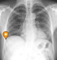 Right costophrenic angle - e-Anatomy - IMAIOS