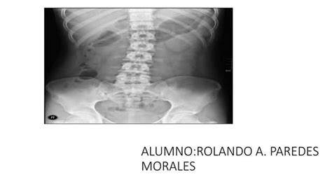 Colitis ulcerosa | PPT