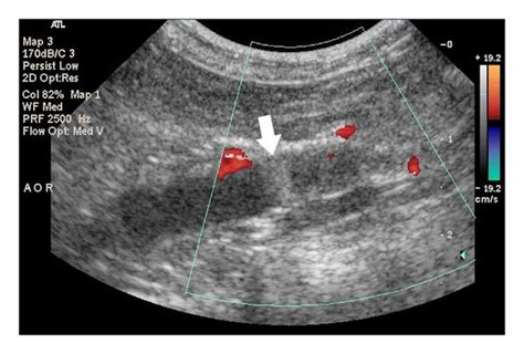 Abdominal ultrasound at the level of the aortic bifurcation. The... | Download Scientific Diagram