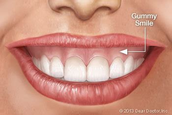 Gummy Smile Causes and Corrections | Dr. Conness Explains