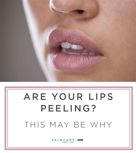 Why Are My Lips Peeling? Here's How to Treat Dry, Peeling Lips | Lips ...