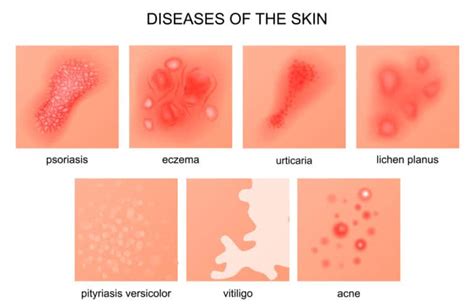 Differences between eczema and psoriasis