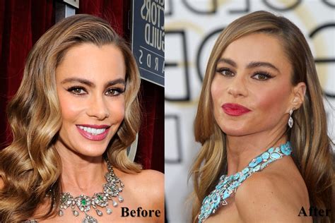 Sofia Vergara Plastic Surgery Face Before And After Photos