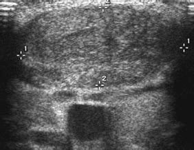 25 Fibromatosis Colli | Radiology Key