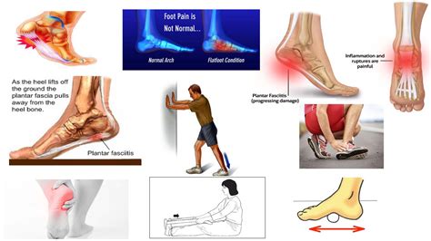 Correct Plantar Fasciitis Quickly! (Medically Proven) The Best Exercises & Stretches - Dr ...