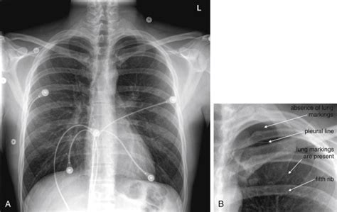 Imaging Chest Trauma | Radiology Key